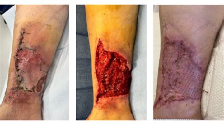 Can you put vitamin C on an open wound?