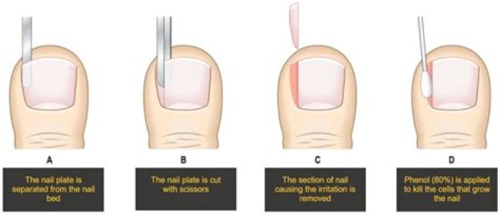 Does cutting an ingrown toenail make it worse?