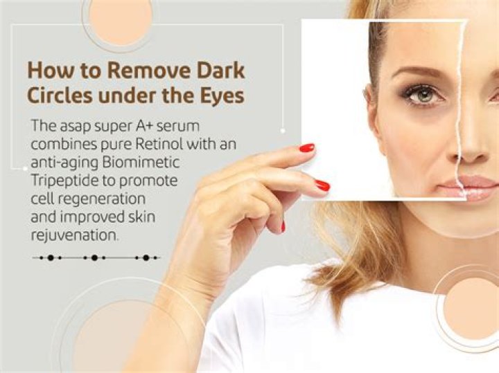 Does sleeping more remove dark circles?