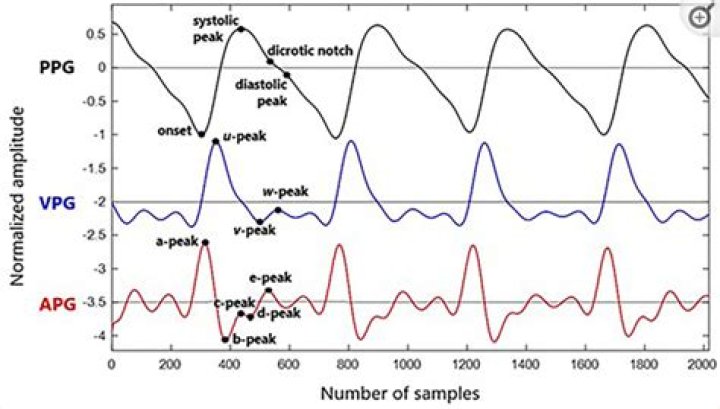 Is PPG better than ECG?