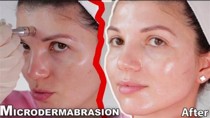 What can go wrong with microdermabrasion?