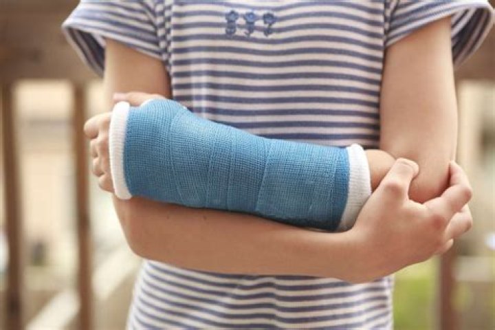 What is a plaster cast made of?